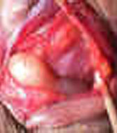 Orbital Tumors - Lacrimal Gland Tumors